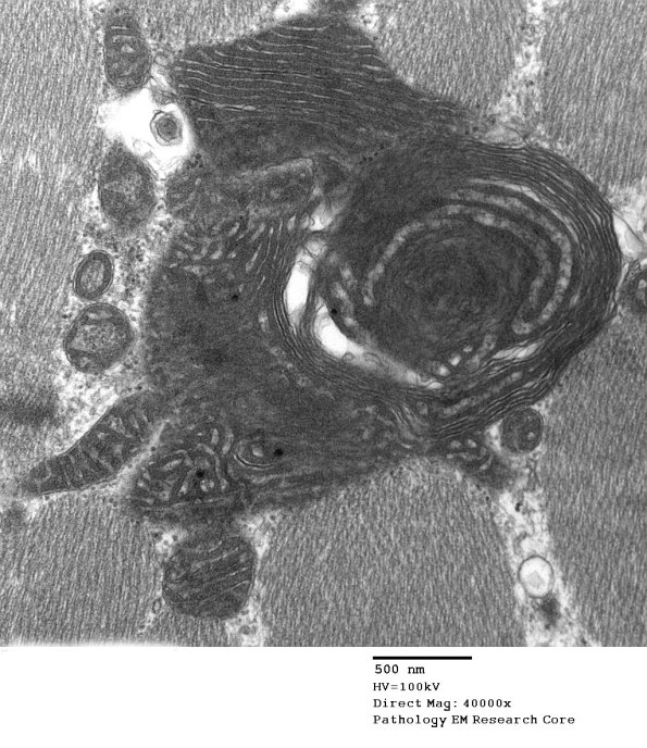 5F3B Mitochondrial myopathy TWINKLE (Case 5) EM25 - Copy