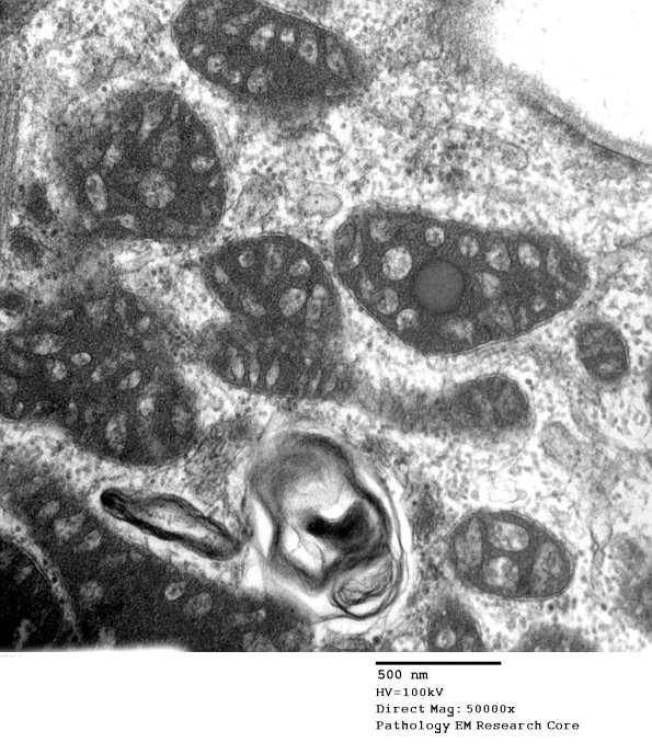 5F4 Mitochondrial myopathy TWINKLE (Case 5) EM 003 - Copy