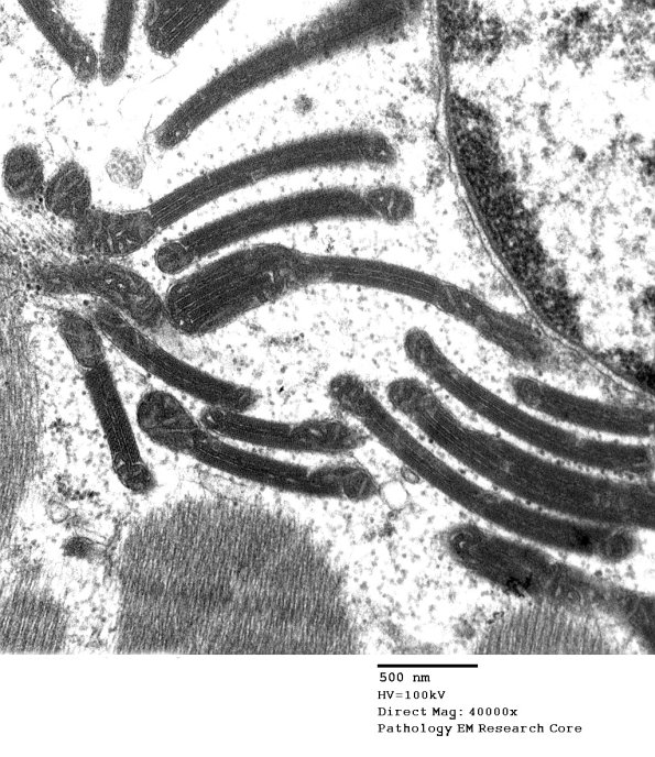 5F7B Mitochondrial myopathy TWINKLE (Case 5) EM 016 - Copy