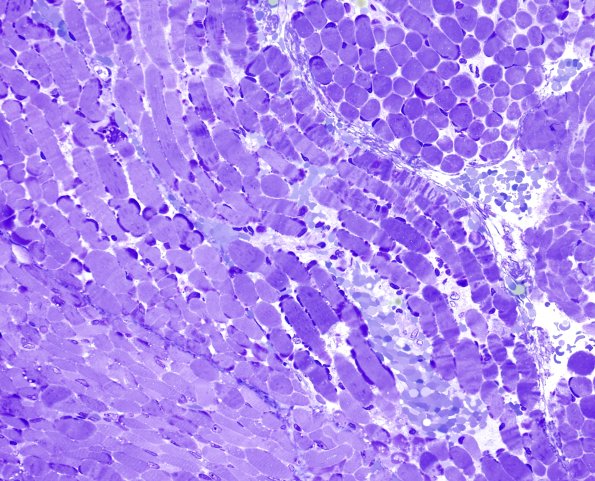 6A1A Mitochondriopathy (Case 6) Plastic 1