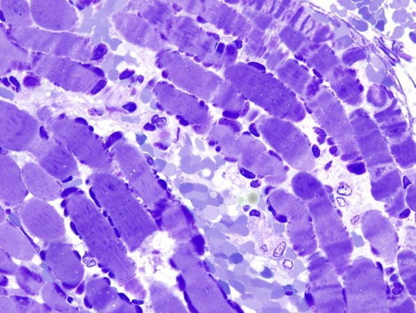 6A1B Mitochondriopathy (Case 6) Plastic 3
