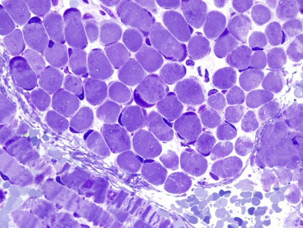 6A1C Mitochondriopathy (Case 6) Plastic 4