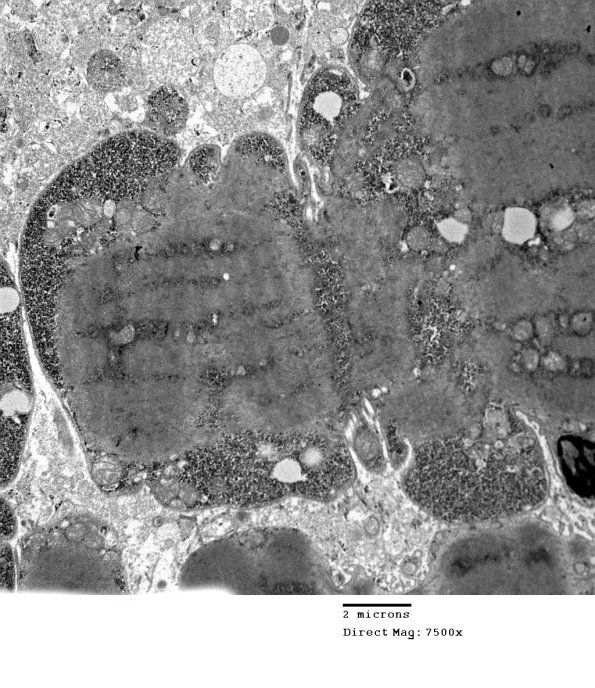 6B1A Mitochondriopathy (Case 6) EM 002 - Copy