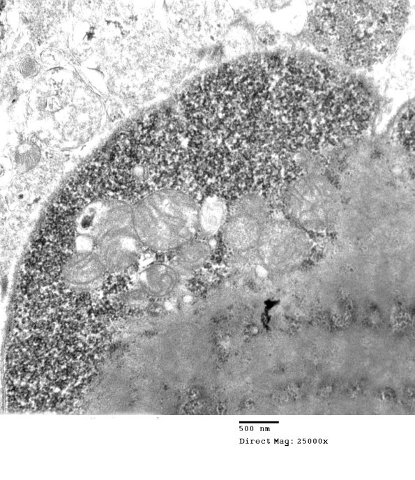 6B1B Mitochondriopathy (Case 6) EM 003 - Copy
