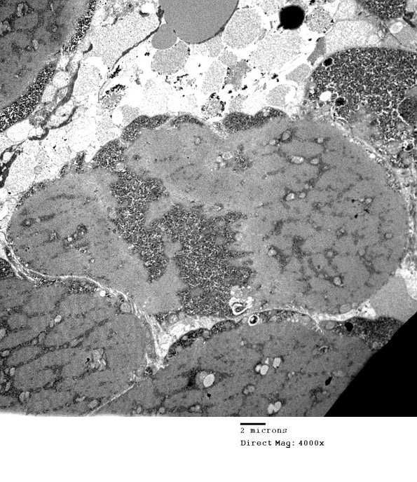6B2 Mitochondriopathy (Case 6) EM 008 - Copy