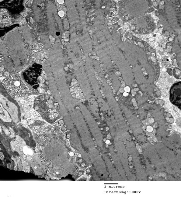 6B3A Mitochondriopathy (Case 6) EM 010 - Copy