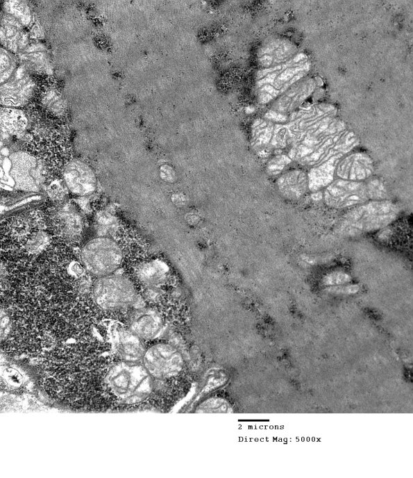6B3B Mitochondriopathy (Case 6) EM 011 - Copy