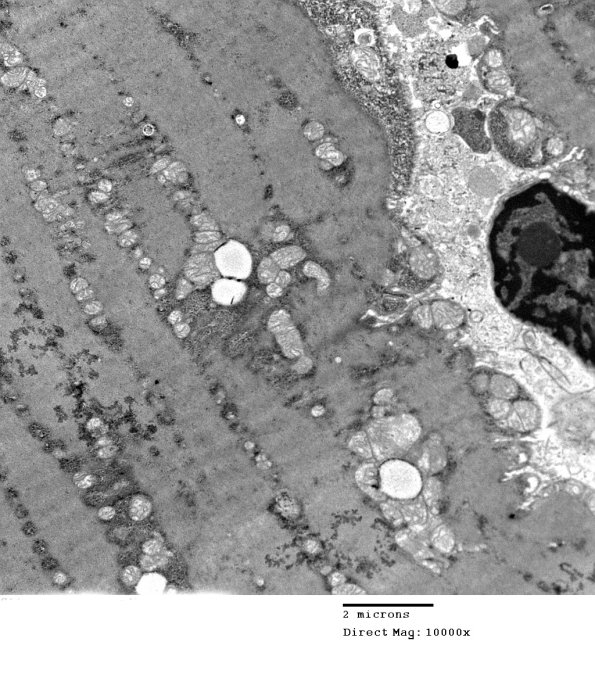 6B3C Mitochondriopathy (Case 6) EM 014 - Copy