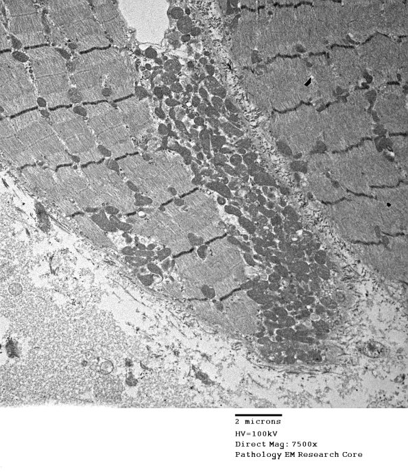 7A1A Mitochondriopathy (Case 7) EM 016 - Copy