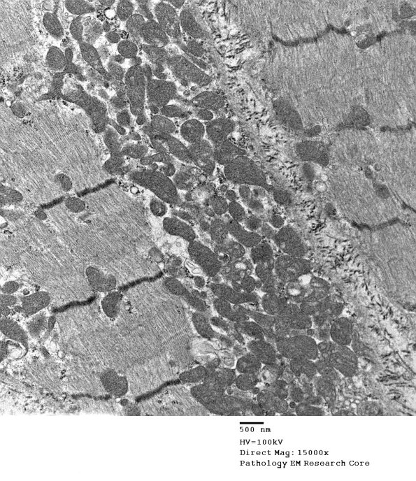 7A1B Mitochondriopathy (Case 7) EM 017 - Copy