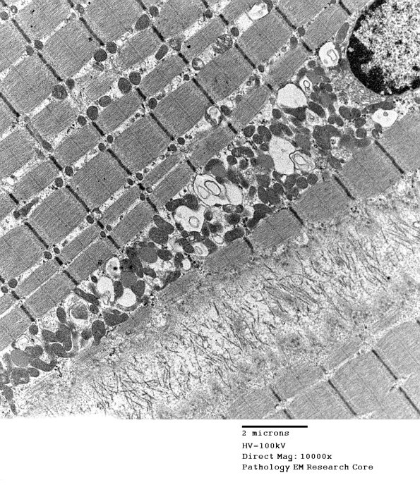 7A2 Mitochondriopathy (Case 7) EM 002 - Copy