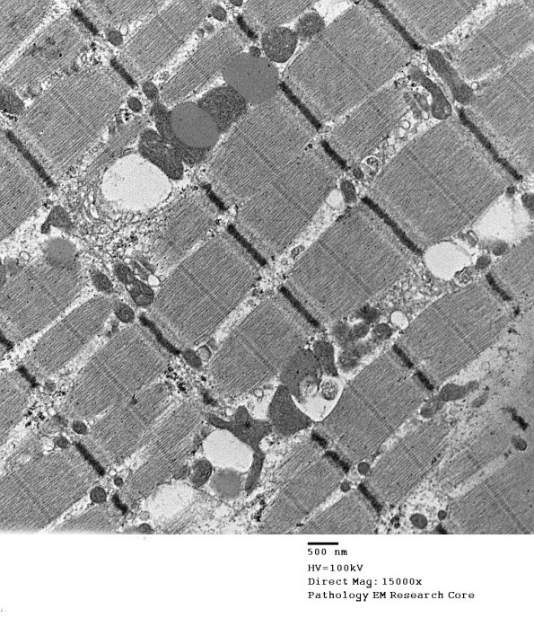 7A3 Mitochondriopathy (Case 7) EM 005 - Copy