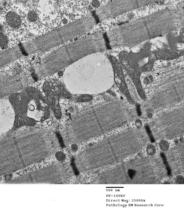 7A5 Mitochondriopathy (Case 7) EM 012 - Copy