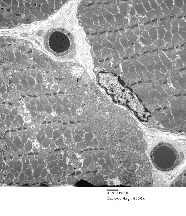 8A1A Mitochondrial Myopathy (Case 8) 041 - Copy