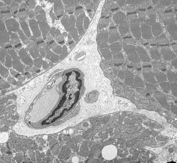 8A2 Mitochondrial Myopathy (Case 8) 034 - Copy