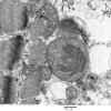 8A3 Mitochondrial Myopathy Case 8) 008 - Copy