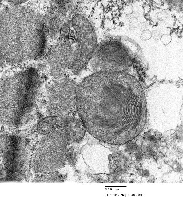 8A3 Mitochondrial Myopathy Case 8) 008 - Copy