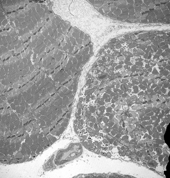 8A4A Mitochondrial Myopathy (Case 8) 027 - Copy