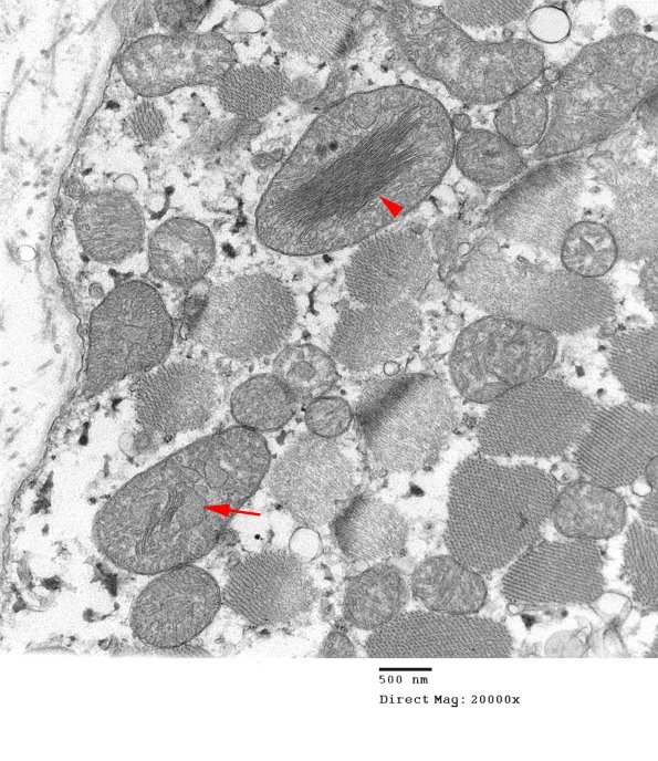 8A4B Mitochondrial Myopathy (Case 8) 031 copy - Copy