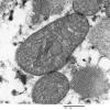 8A4CMitochondrial Myopathy (Case 8) 032 - Copy