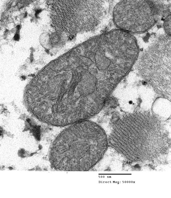 8A4CMitochondrial Myopathy (Case 8) 032 - Copy