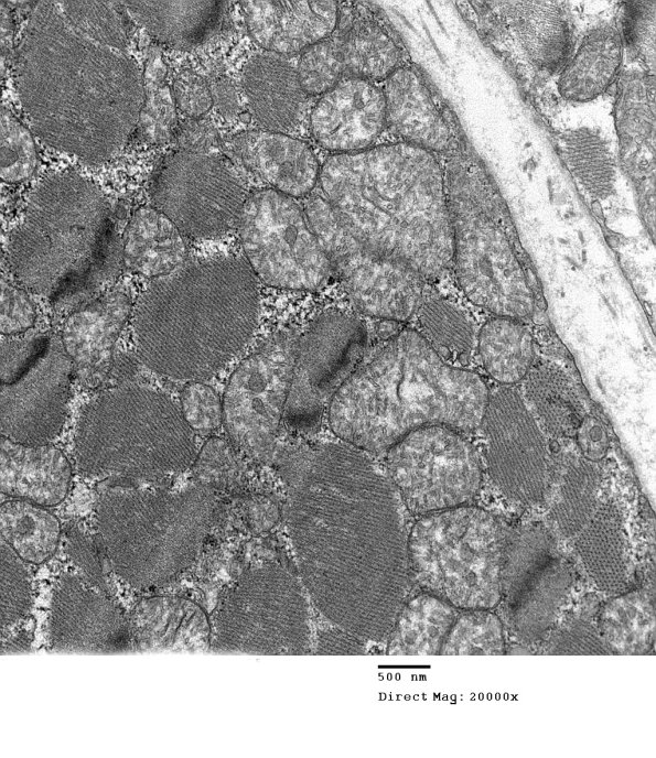 8A5A Mitochondrial Myopathy (Case 8) 010 - Copy
