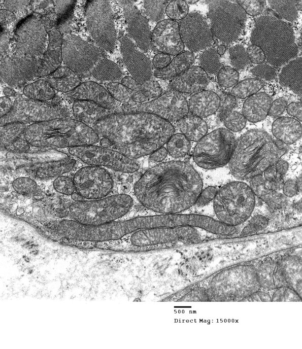 8A5C Mitochondrial Myopathy (Case 8) 023 - Copy
