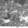 8A5D Mitochondrial Myopathy (Case 8) 024 - Copy