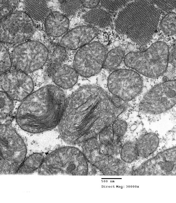 8A5D Mitochondrial Myopathy (Case 8) 024 - Copy