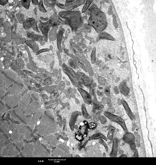 9A1 Mitochondria myopathy (Case 9A) - Copy