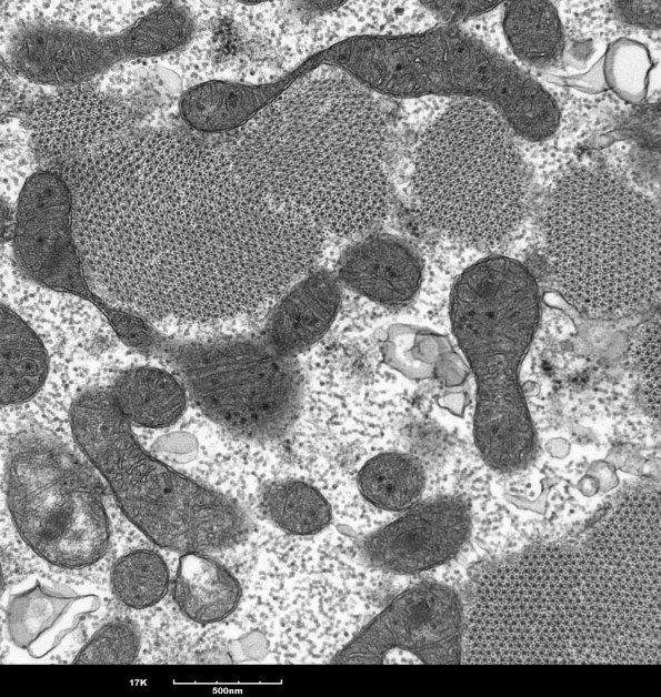 9A2 Mitochondria myopathy (Case 9A)_11 - Copy