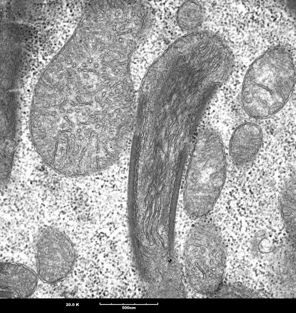 9A3 Mitochondria myopathy (Case 9A) _5 - Copy
