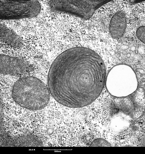 9A4 Mitochondria myopathy (Case 9A) - Copy