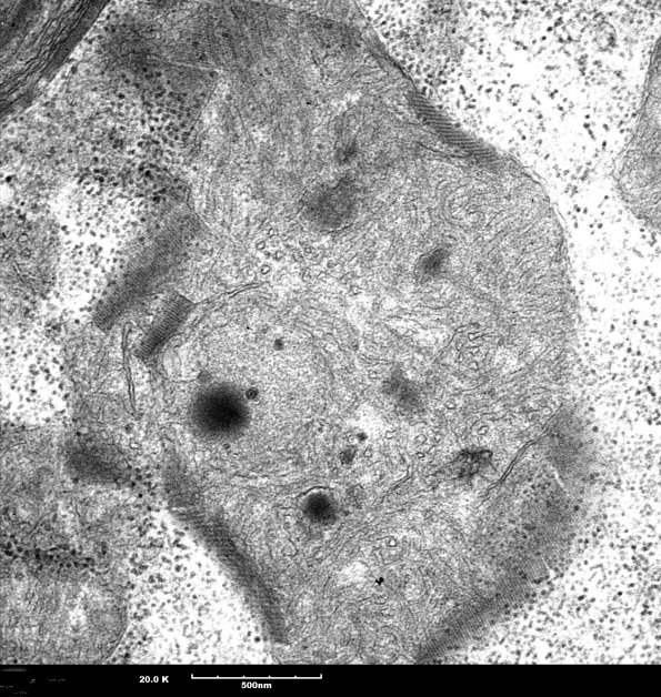 9A5 Mitochondria myopathy (Case 9A)_4 - Copy