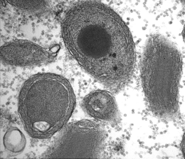 9B1A Mitochondria myopathy (Case 9B) 16 - Copy