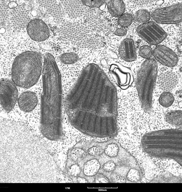 9B1B Mitochondria myopathy (Case 9B) 2 - Copy