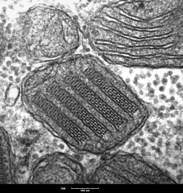 9B1C Mitochondria myopathy (Case 9B) 3 - Copy