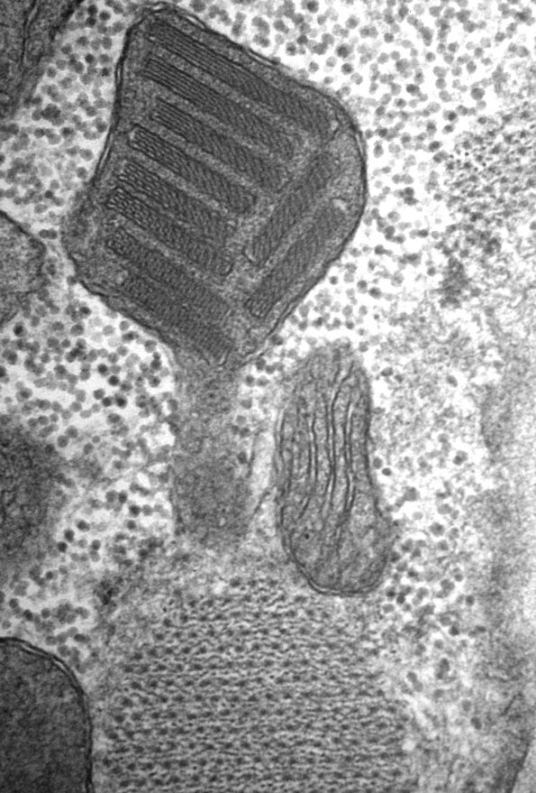 9B1D Mitochondria myopathy (Case 9B) 5 - Copy