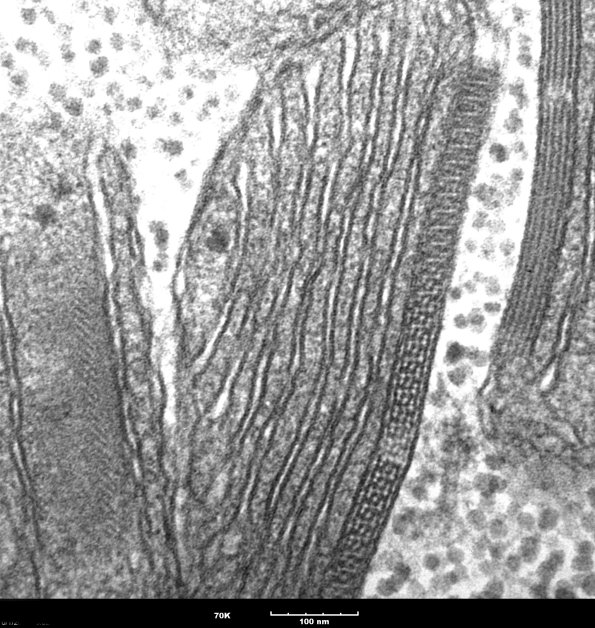 9B1F Mitochondria myopathy  (Case 9B) 4 - Copy
