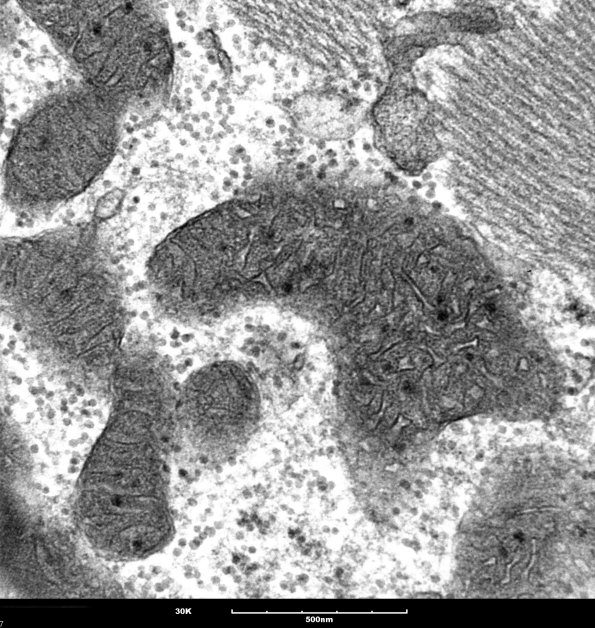 9B2 Mitochondria myopathy (Case 9B) 12 - Copy