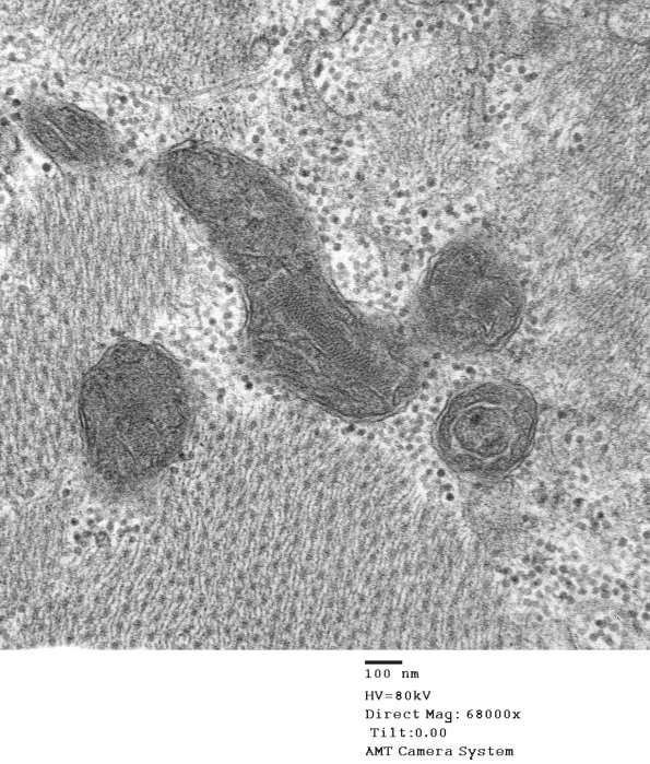 9B3 Mitochondria myopathy (Case 9B) - Copy