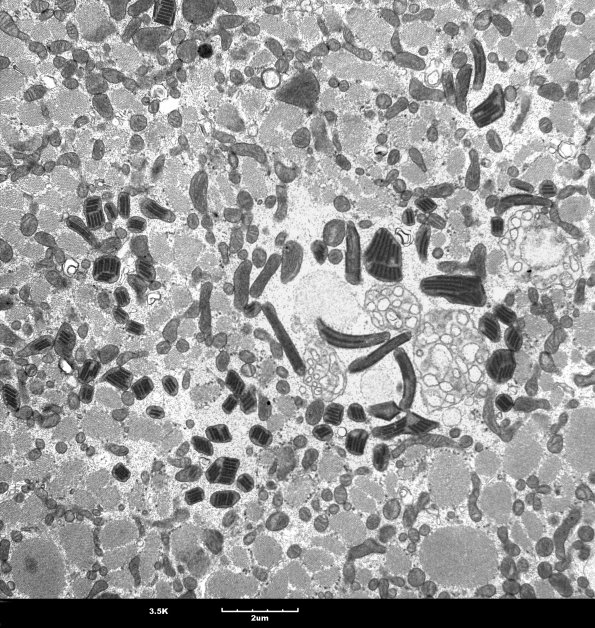 9B4 Mitochondria myopathy (Case 9B) - CopyA
