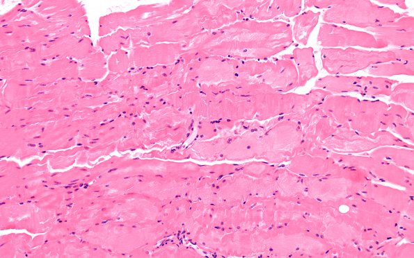 1A1 Myosin Loss Myopathy, patchy (Case 1) H&E 6