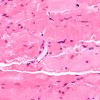 1A2 Myosin Loss Myopathy, patchy (Case 1) H&E 5