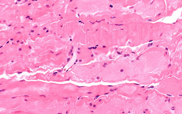 1A2 Myosin Loss Myopathy, patchy (Case 1) H&E 5