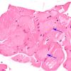 1A3 Myosin Loss Myopathy, patchy (Case 1) H&E 2 copy