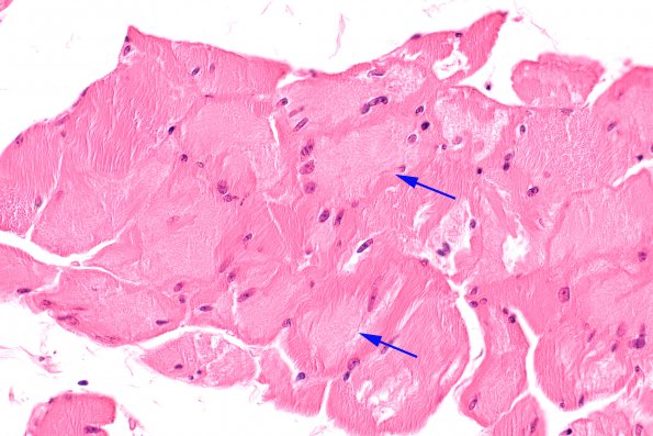 1A3 Myosin Loss Myopathy, patchy (Case 1) H&E 2 copy