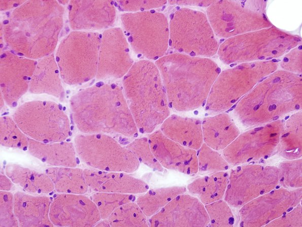 1A4 Myosin Loss Myopathy, patchy (Case 1) H&E 5