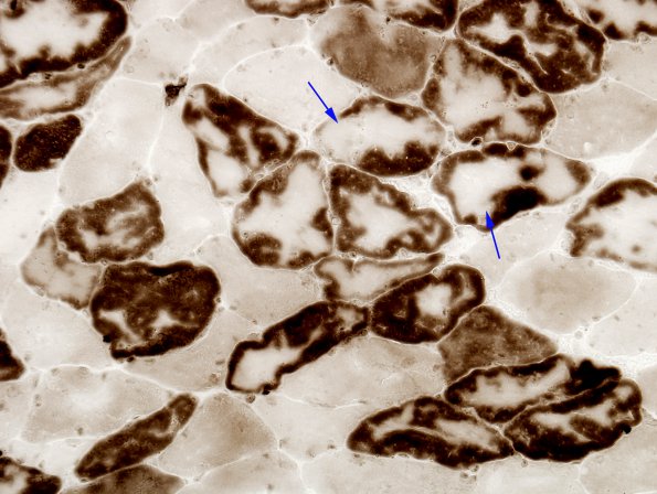 1B2 Myosin Loss Myopathy, patchy (Case 1) ATPase 4