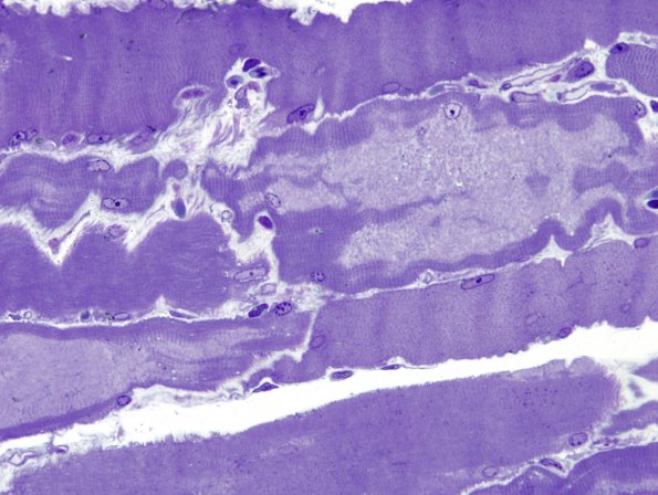 1D1 Myosin Loss Myopathy, patchy (Case 1) Plastic 1